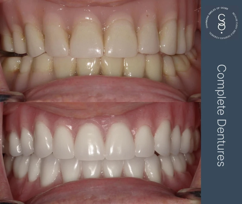 Complete Dentures before and after
