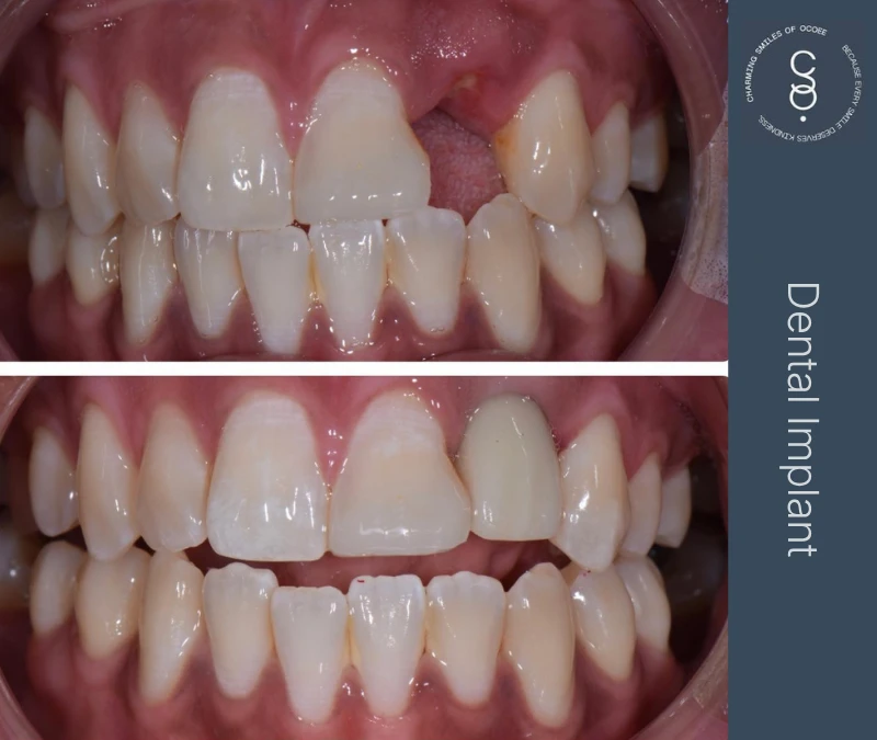 Dental Implant before and after