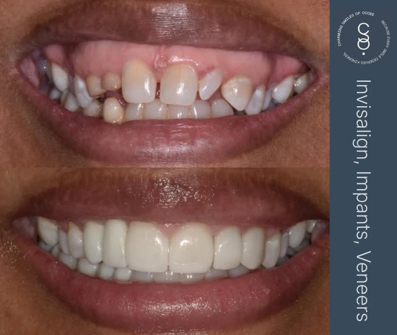 Invisalign, Implants and Veneers before and after
