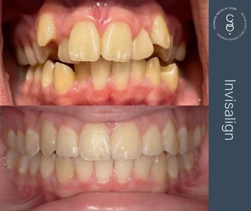 Invisalign before and after