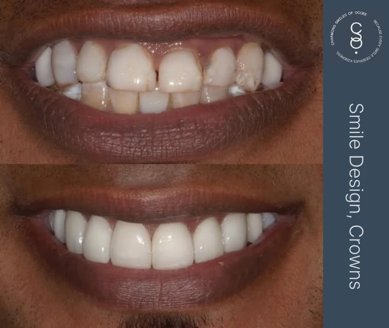 Smile Design and Crowns before and after